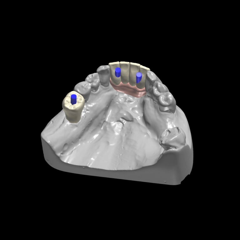 PMMA Screw Retained Provisional Implant Restorations Sculpture Studios